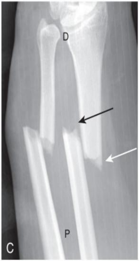 <p>fracture orientation</p>