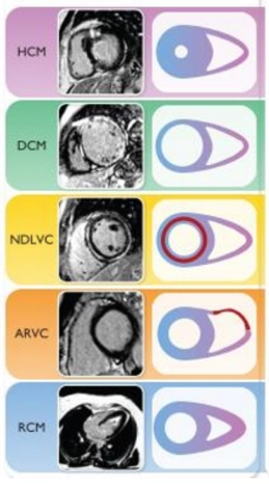 <ul><li><p>hypertrophic</p></li><li><p>dilatative</p></li><li><p>non dilated left ventricular</p></li><li><p>arrhythmogenic</p></li><li><p>restrictive</p></li><li><p>un classified- non compaction, Tako-Tsubo</p></li></ul><p></p><p></p>