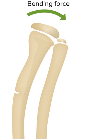 <p>when a bone bends and cracks on one side without fully breaking </p>