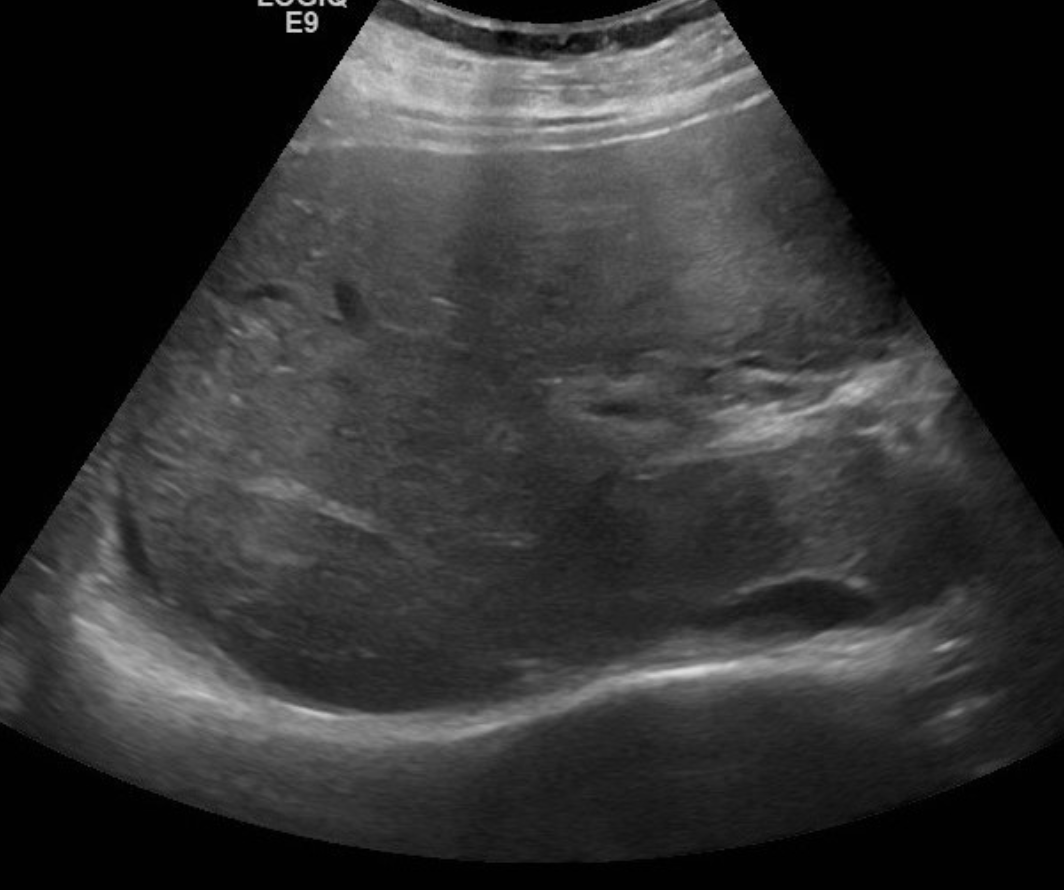 <p>What are the indications and things we’ll see on ultrasound on someone with chronic PV thrombosis</p>