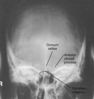 <p><span style="background-color: transparent;">Towne - skull</span></p>