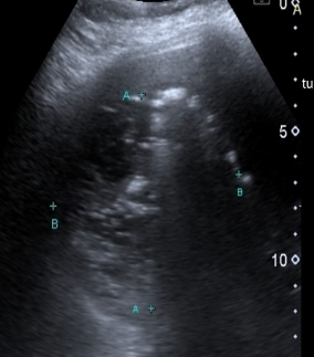 <ol><li><p>Complex cystic mass</p></li><li><p>Cluster sign seen as cluster of small abscesses</p></li><li><p>Reverberation or ringdown artifact </p></li></ol><p></p>