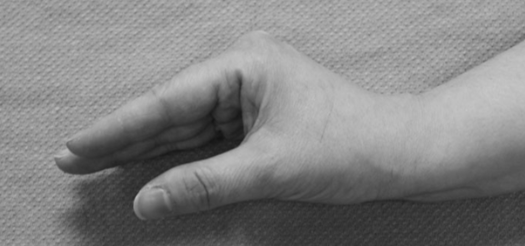 <p>The intrinsic muscles put the hand into a protective/functional posture. Imbalance of spastic intrinsics and weak extrinsic (FDS, FDP, EDC).</p><p>Position: MCP flexion, PIP extension, DIP extension</p><p>Cause: trauma (direct/indirect, vascular injury, compartment syndrome), RA, neurologic injury</p>