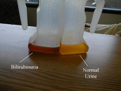 <p>Hemoglobinuria and Bilirubinuria</p>