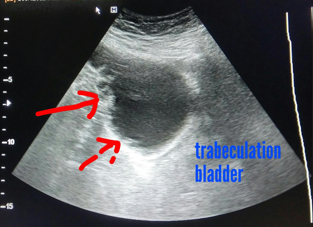 <p>- thickened bladder wall and trabeculae</p><p>- urinary retention</p><p>- distended bladder but no urgency</p>