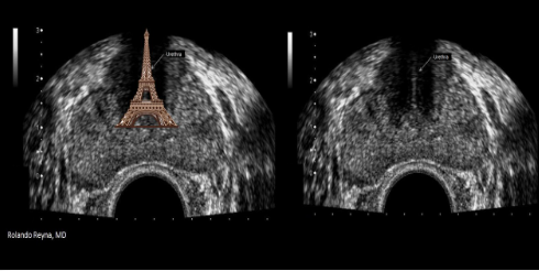 <p>USA prostate </p>