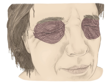 <p>Orbicularis oculi action</p>