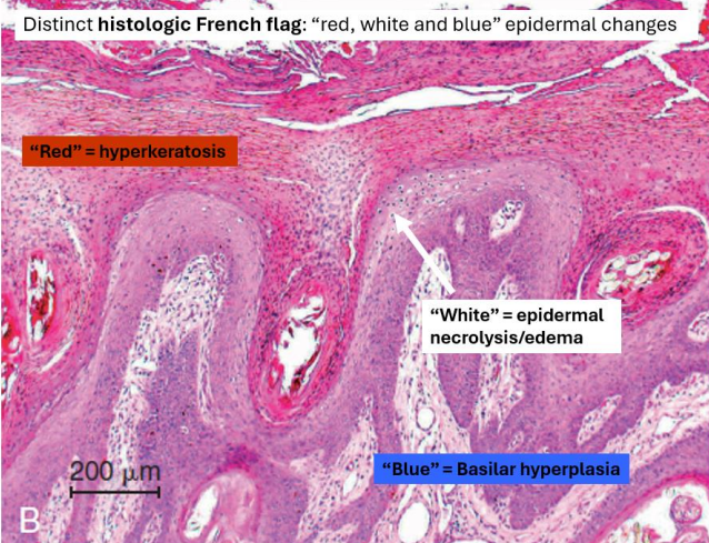 <ul><li><p>distribution of infiltrate: superficial</p></li></ul><ul><li><p><strong>lymphocytic</strong> ± neutrophilic infiltrate</p></li><li><p>epidermal changes: hyperkeratosis (parakeratosis), necrosis, basal hyperplasia</p></li></ul><p></p>