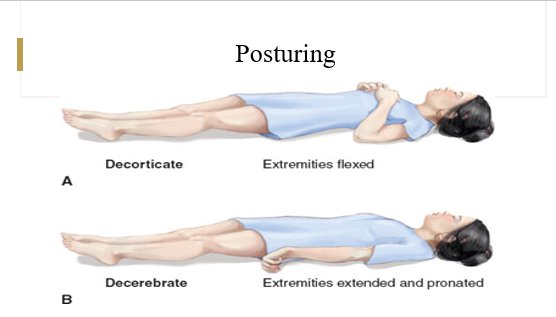 <p>-an involuntary flexion or extension of the arms and legs, indicating severe brain injury</p>