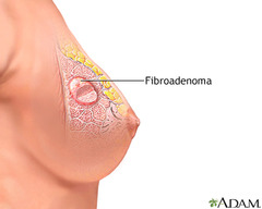 <p>Benign tumor of stromal/epithelial tissue.</p><p>Well-circumscribed, rubbery, firm, mobile ("slips under fingers").</p><p>Common in women <30 yrs, often painless.</p>