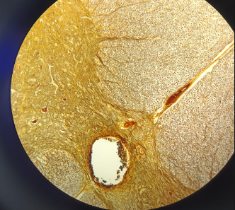 <p>Ganglion Spinale - AgNO3</p><ul><li><p><strong>Neurons:</strong> Contains <strong>pseudounipolar neurons</strong> (T-shaped neurons).</p></li><li><p><strong>Satellite Cells:</strong> Neuron bodies are surrounded by a "<strong>mud-like</strong>" layer of <strong>satellite cells</strong> for protection/trophic function.</p></li><li><p><strong>Note:</strong> There are <strong>no synapses</strong> in this structure; the description is identical for both HE and Silver slides.</p></li></ul><p></p>