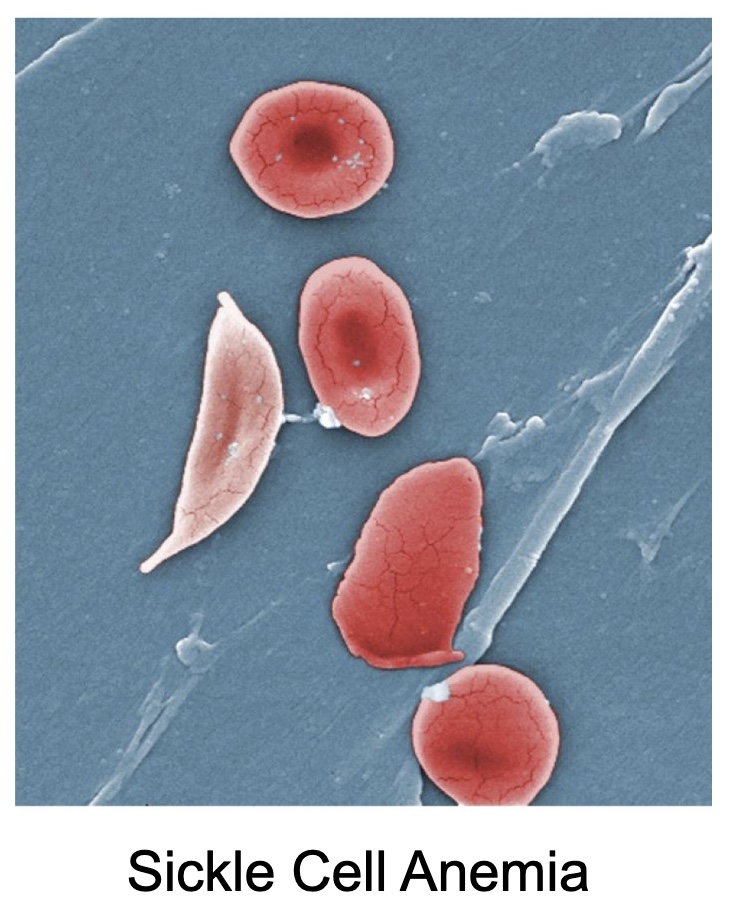 <p>Sickle Cell, Iron-deficiency, Vitamin deficiency, Megaloblastic, Pernicious, Celiac</p>