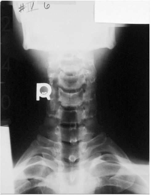 <p>Is this film of diagnostic quality (AP Lower Cervical)</p>
