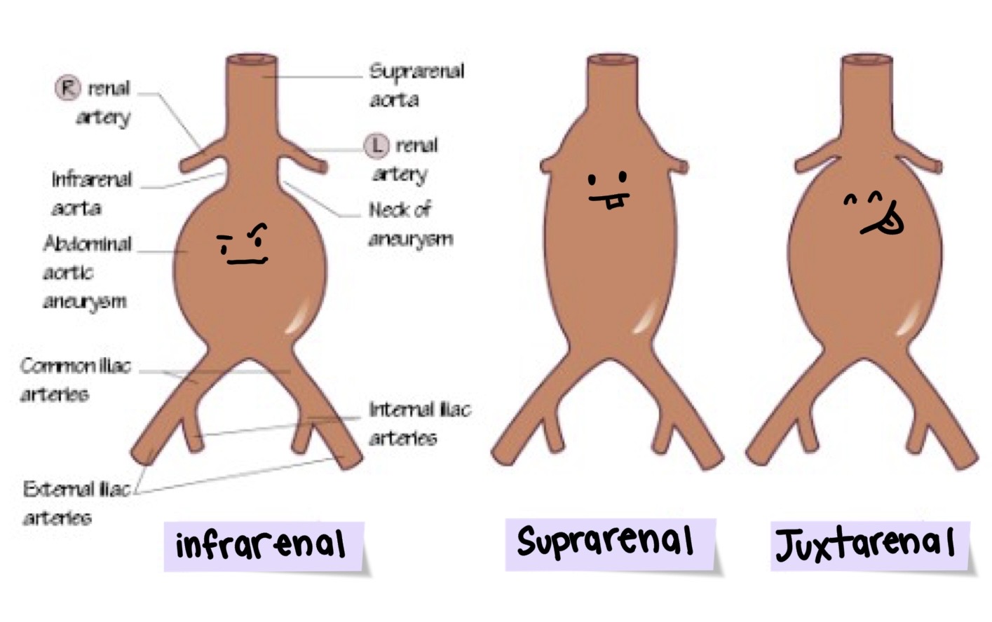 <p>What are the most common locations for aneurysms</p>
