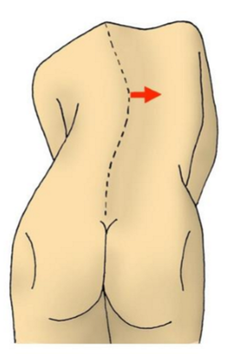 <p>What does the following image display an example of, & how might this occur? What are some implications of severity of this condition?</p>