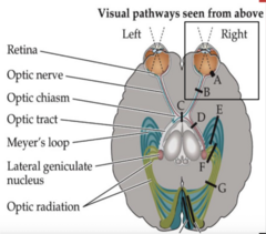<p>lesions of the retina or optic nerves produce</p>