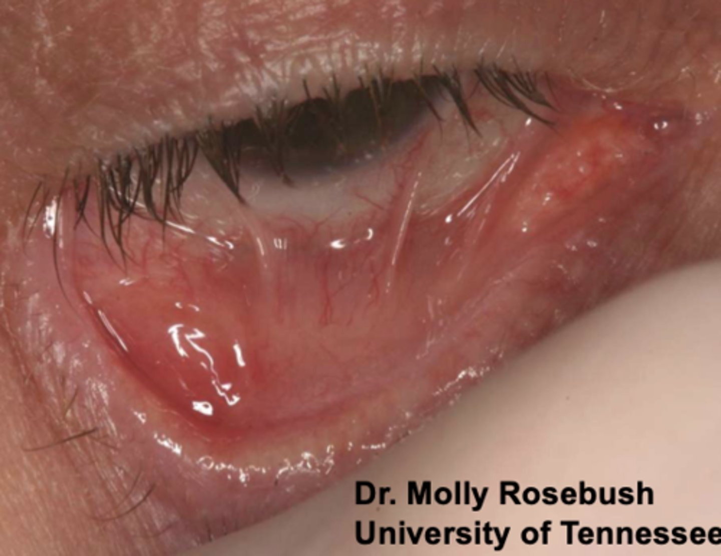 <ol><li><p><strong>Symblepherons</strong> (adhesions)</p></li><li><p><strong>Entropions</strong> (inward turning eyelids)</p></li><li><p><strong>Trichiasis </strong>(irritation secondary to eyelids rubbing against globe)</p></li></ol><p></p>