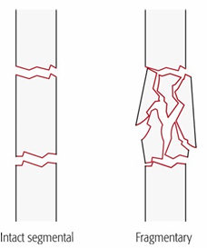 <p>Many fracture lines and fragments; previously called “complex.”</p>
