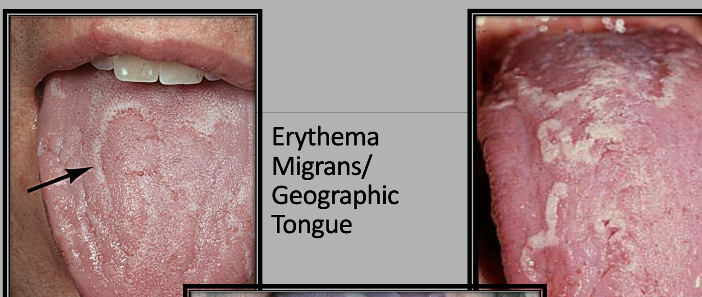 <p>erythema</p><p>irregular</p><p>Tortuous, scalloped, serpentine like</p><p>❖White to yellow</p>