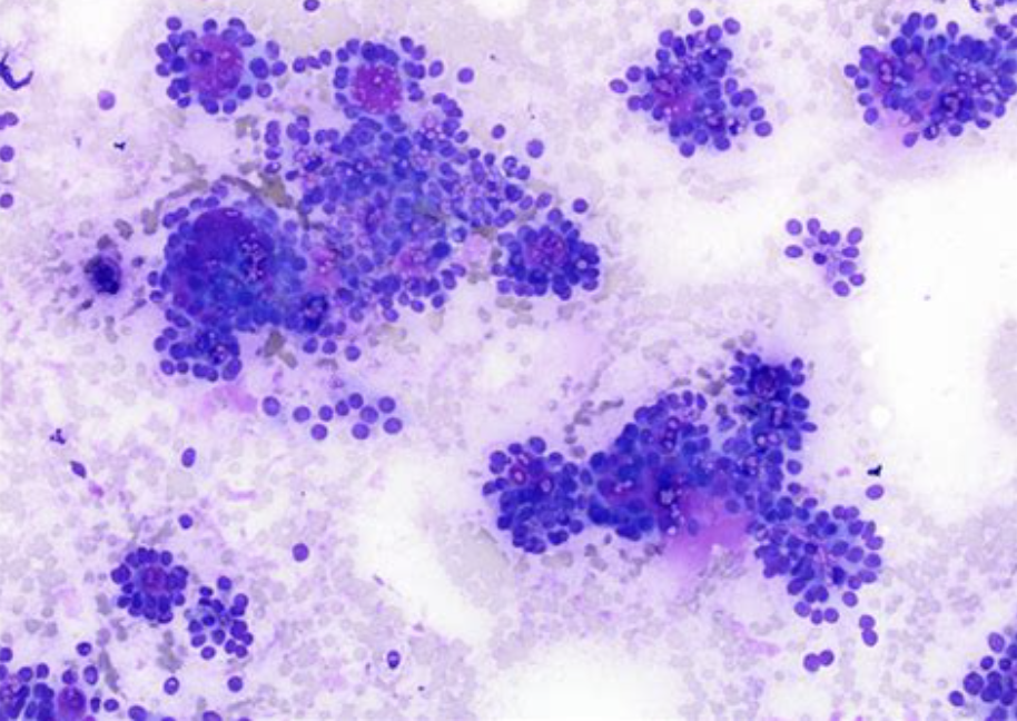 <p>Cytologie salivaire (glandes mineures)</p><p>1) Catégorie selon Milan</p><p>2) Diagnostic</p>