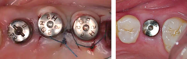 <p><span>In this procedure, the coronal portion stays exposed through the gingiva during the healing period</span></p><p><span>• The </span><span style="color: rgb(255, 0, 0);">healing abutment </span><span>protrudes about 1-2mm from the crest of bone and flaps are adapted around the implant</span></p>