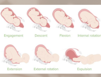 <ol><li><p><span style="color: rgb(230, 160, 160);"><strong>engagement</strong></span></p></li></ol><ul><li><p><span style="color: rgb(230, 160, 160);">head enters pelvis</span></p></li></ul><ol start="2"><li><p><span style="color: rgb(183, 99, 13);"><strong>descent</strong></span></p></li></ol><ul><li><p><span style="color: rgb(183, 99, 13);">head through pelvis</span></p></li></ul><ol start="3"><li><p><span style="color: rgb(84, 140, 33);"><strong>flexion</strong></span></p></li></ol><ul><li><p><span style="color: rgb(84, 140, 33);">infant</span> chin to chest</p></li></ul><ol start="4"><li><p><span style="color: rgb(67, 136, 189);"><strong>internal rotation</strong></span></p></li></ol><ul><li><p><span style="color: rgb(67, 136, 189);">head turns to fit pelvis</span></p></li></ul><ol start="5"><li><p><span style="color: rgb(57, 42, 231);"><strong>extension</strong></span></p></li></ol><ul><li><p><span style="color: rgb(57, 42, 231);">infant chin up</span></p></li></ul><ol start="6"><li><p><span style="color: rgb(248, 40, 213);"><strong>external rotation (restitution)</strong></span></p></li></ol><ul><li><p><span style="color: rgb(248, 40, 213);">realignment and shoulders</span></p></li></ul><ol start="7"><li><p><span style="color: rgb(160, 191, 13);"><strong>expulsion</strong></span></p></li></ol><ul><li><p><span style="color: rgb(160, 191, 13);">baby delivered</span></p></li></ul><p></p><p>*EDFIREEE</p>
