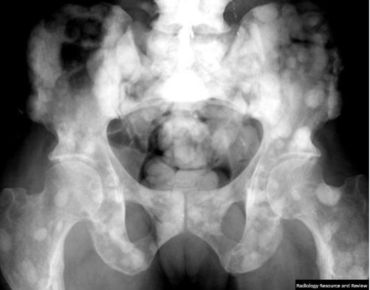 <p>> 40 y.o.; ivory white vertebrae; no cortical thickening or bone enlargement </p>