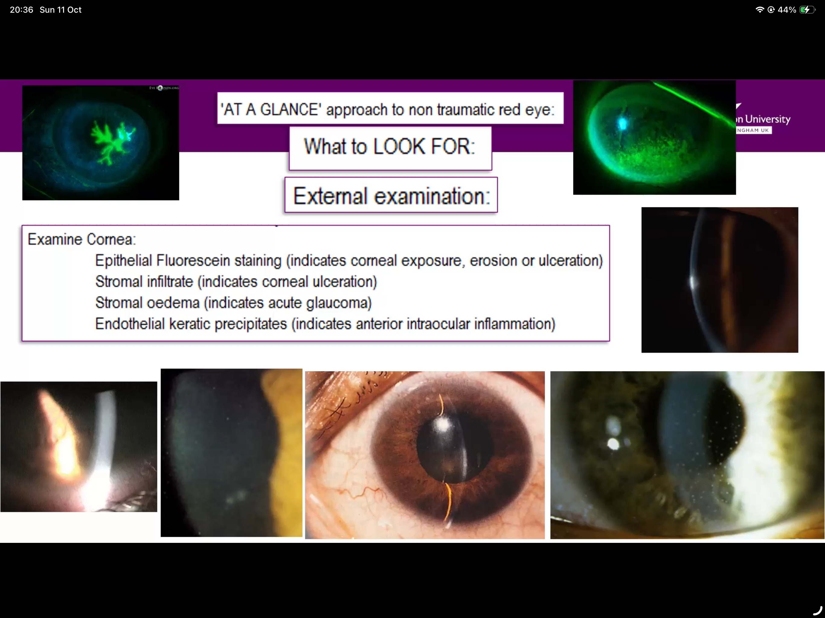 <ul><li><p>Staining indicates erosion/ulceration (top pictures)</p></li><li><p>Stromal infiltrate- indicates corneal erosion (central bottom picture)</p></li><li><p>Stromal oedema indicates acute glaucoma (bottom right)</p></li></ul><p></p>