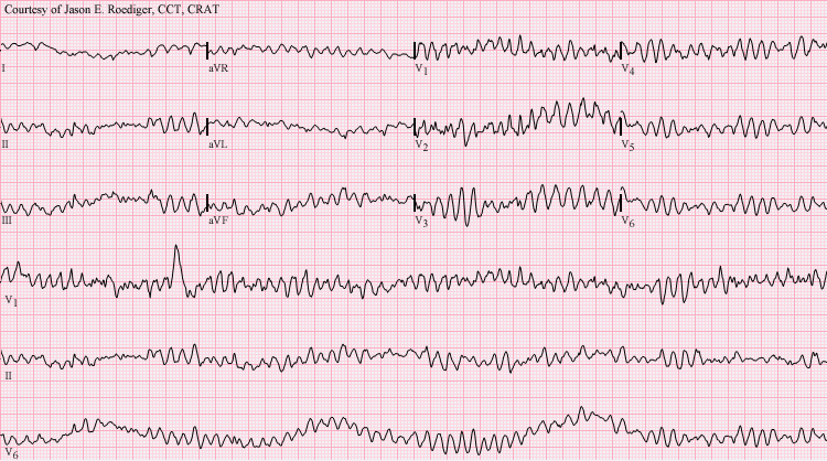 <p>chaotyczny rytm z&nbsp;wychyleniami, które są nieregularne w&nbsp;czasie i&nbsp;pod względem morfologii, bez wyraźnych zespołów QRS w&nbsp;powierzchniowym EKG.</p><p></p><p>sinusoida w totalnie zmiennej amplitudzie z bardzo szybką akcją komór</p><p>szybka i nieskoordynowana praca komór serca</p><p></p><p>częste pobudzenia mięśnia sercowego w okresie refrakcji względnej</p>