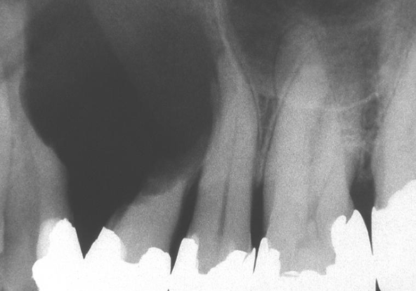 <p>root resorption suggests __ behavior, root divergence suggests __ process (central giant cell granuloma)</p>