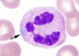 <p>Which Reactive Neutrophil Change is associated with a PALE BLUE inclusion in the neutrophil, associated with infection SEPSIS AND PREGNANCY </p>
