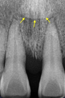 <p>Incisive foramen</p>