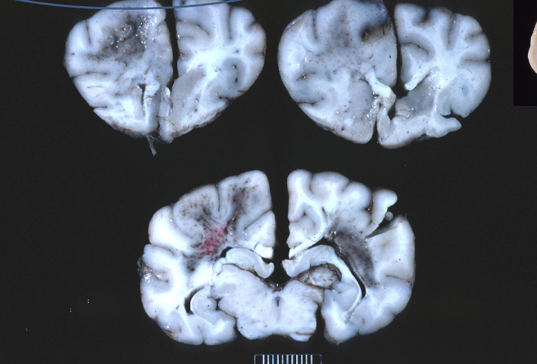 <p>Where is the lesion located and is it a polioencephalopathy or a leukoencephalopathy?</p>