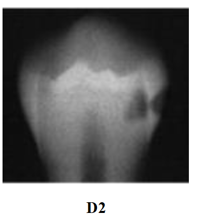 <p>Radiolucency in the middle third of dentin</p>