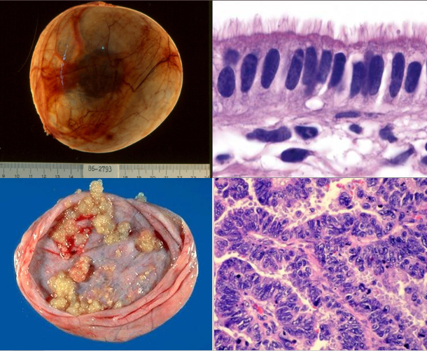 <p>surface epithelium serous ovarian tumors?</p>