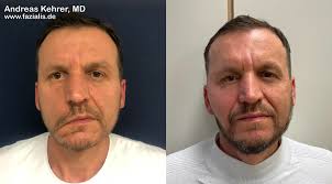 <p> Check the nasolabial folds for drooping. Then ask the patient to smile, frown, puff out their cheeks, raise their eyebrows, and close their eyes tight</p>