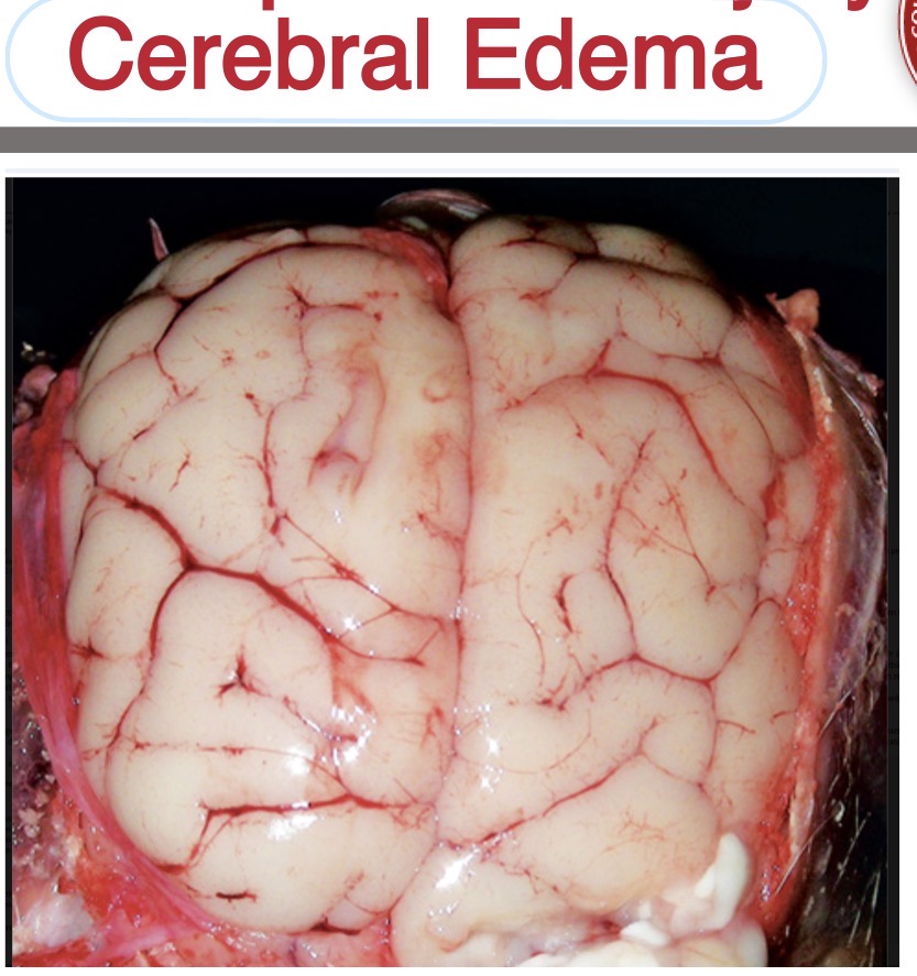 <p>brain, cerebral edema</p>