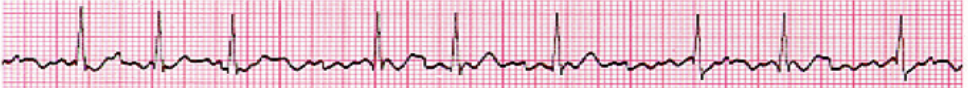 <ul><li><p>no distinct P waves (irregular R-R spacing), no PR, atrial rate = 300-600 bpm, ventricular rate (untx) = 100-180 bpm</p></li><li><p>decrease CO d/t loss of atrial kick (20% ventricular filling)</p></li><li><p>premature ventricular contraction (PVC) early, full pause after, no pulse (irregular rhythm)</p></li><li><p><strong>causes: </strong>HEART DISEASE (HF, constrictive pericarditis, ischemic/rheumatic heart disease, mitral stenosis, atrial irritation, complication of CABG/valve replacement), COPD, PE, HTN, DM, thyroid dz, sepsis</p></li><li><p><strong>risk factors:</strong> uncontrolled BG, hyperthyroidism, kidney dz, OSA, smoking, alcohol, sedentary lifestyle, over 60</p></li><li><p><strong>sxs:</strong> HEART PALPITATIONS, fatigue, dyspnea, lightheadedness, chest pain</p></li><li><p><strong>tx:</strong> synchronized cardioversion, meds (metoprolol, diltiazem/CCB, digoxin), anticoagulant (reduce CVA and MI risk)</p></li></ul><p></p>