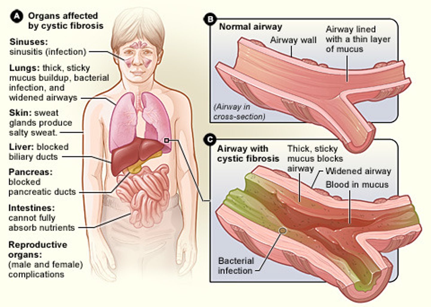 <p>A genetic disorder that is present at birth and affects both the respiratory and digestive systems. Autosomal recessive.</p>