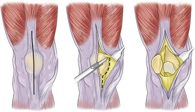 <p>Standard approach: through the quadriceps tendon, around the medial patella, to the tibial tubercle.</p>