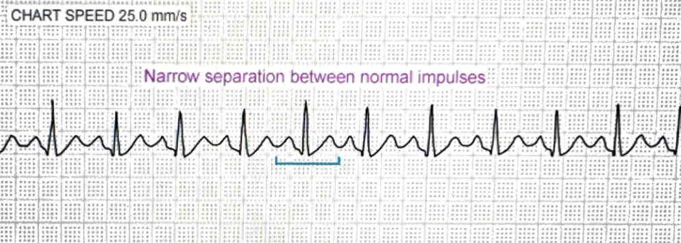 <p>Regular rhythm, normal P before every QRS, but rate >100 bpm</p>