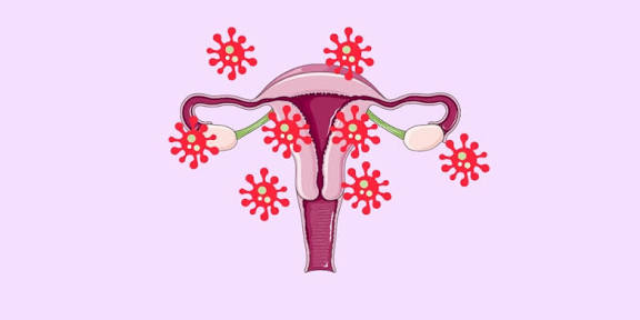 <p>Postpartum infection</p>