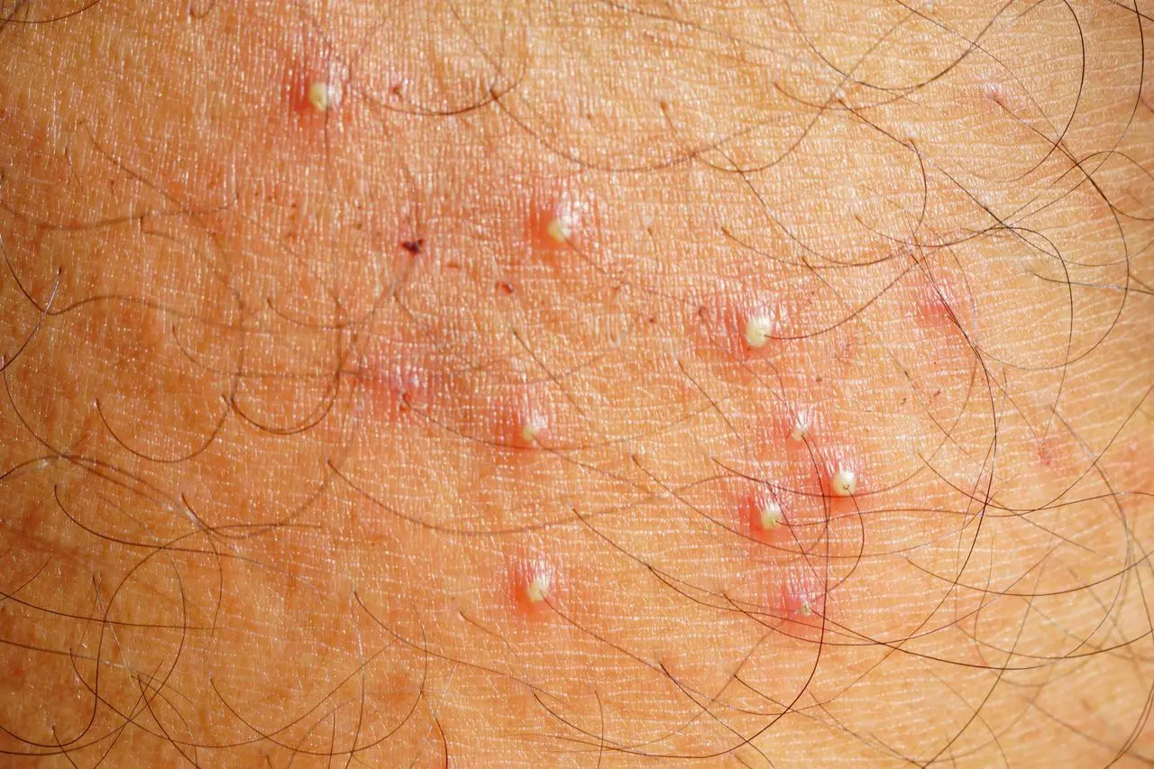 <p>Inflammation and infection of the hair follicle and surrounding dermis.</p>