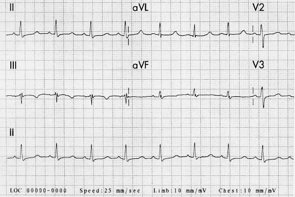 <p>howd yk this is Hypocalcemia</p>