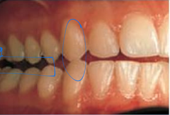 <p>What term describes the eccentric position where the canines are the only teeth touching?</p>