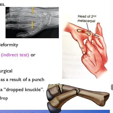 <ul><li><p>The athlete generally presents with dorsal hand pain, swelling and deformity </p></li><li><p>Pain on direct palpation and axial load through fingers/MCP joint (indirect test) or squeeze from side for 2nd and 3rd metacarpals </p></li><li><p><strong>Bennet’s fracture</strong> is an injury to the 1st metacarpal- usually surgical </p></li><li><p><strong>Boxer’s fracture </strong>is most common in 5th, then 4th metacarpal as a result of a punch </p></li><li><p>Often see flexion deformity of the distal fragment that results in a “dropped knuckle”. </p></li><li><p>The more proximal the fracture, the greater the knuckle will drop</p></li></ul><p></p>