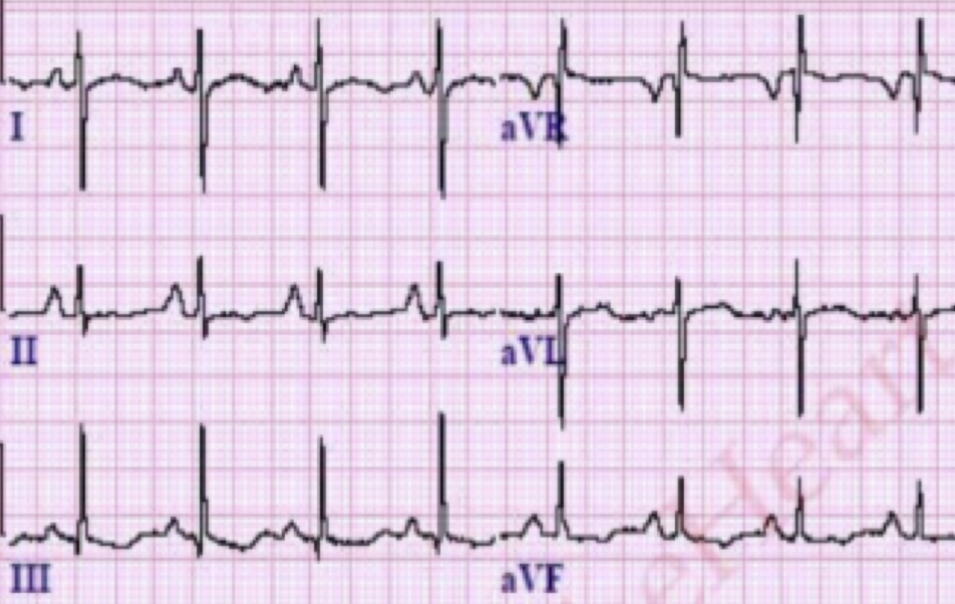 <p>QRS Classification for this tracing</p>