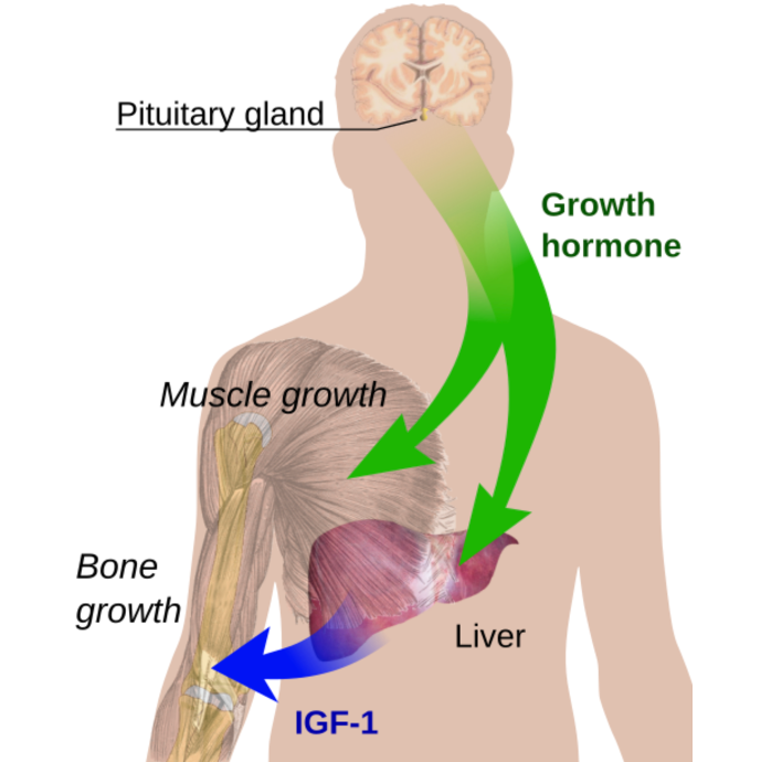 <ul><li><p>S/S</p><ul><li><p>Short stature </p></li><li><p>Poor growth </p></li><li><p>Delayed puberty and facial development </p></li></ul></li><li><p>Diagnosis </p><ul><li><p>Rule out other reasons (genetic, FTT) </p></li><li><p>Wrist x-ray to assess “bone age” </p></li><li><p>End-organ blood testing (IGF-1) </p></li></ul></li><li><p>Treatment </p><ul><li><p>Daily SQ GH injections (earlier is better) </p></li><li><p>Address underlying causes (tumor, head injury) </p></li></ul></li></ul><p></p>