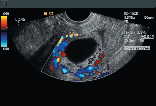 <p>11. The adnexal finding in Figure 23-34 was discovered in a patient with a live 8-week IUP. She did not complain of pain or vaginal bleeding. What is the most likely diagnosis?</p><p></p><p>a. Corpus luteum</p><p>b. Ectopic pregnancy</p><p>c. Heterotopic pregnancy</p><p>d. Blighted ovum</p>
