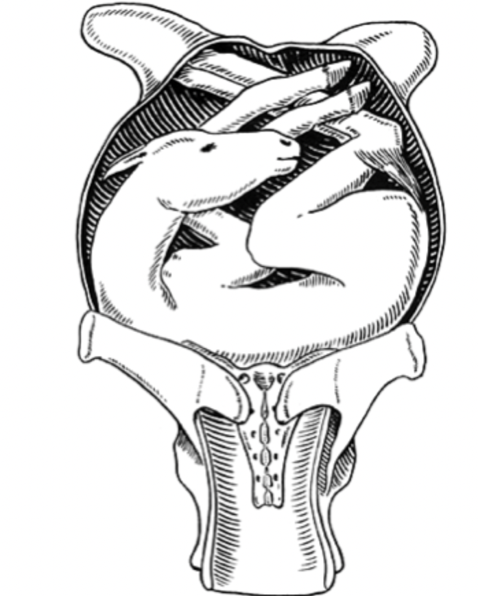 <p>What abnormal presentation is shown in the image?</p>